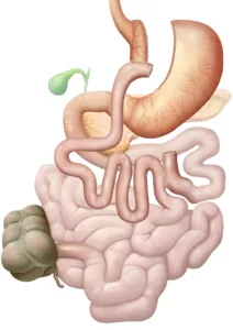Darstellung Adipositaschirurgie: Magenbypass Operation gegen Fettleibigkeit beim Menschen mit krankhafter Adipositas. Der Effekt der Gewichtsreduktion beruht vor allem darauf, dass durch die Umstellung der Dünndarmlängen weniger Energieträger (Fette, Zucker, Proteine) durch die Nahrung in den Körper aufgenommen werden. Bei der Adipositas (Fettleibigkeit, Obesitas, Fettsucht) handelt es sich um eine Ernährungs- und Stoffwechselkrankheit mit starkem Übergewicht. Der Verdauungstrakt (Verdauungsapparat, Apparatus digestorius) umfasst die Organe die der Aufnahme, der Zerkleinerung und dem Weitertransport der Nahrung dienen, um diese letztlich zu verdauen und die darin enthaltenen Nährstoffe für den Körper verwertbar zu machen, zusammen. Als Verdauung (Digestion) bezeichnet man den Aufschluss der Nahrung im Verdauungstrakt mit Hilfe von Verdauungsenzymen.